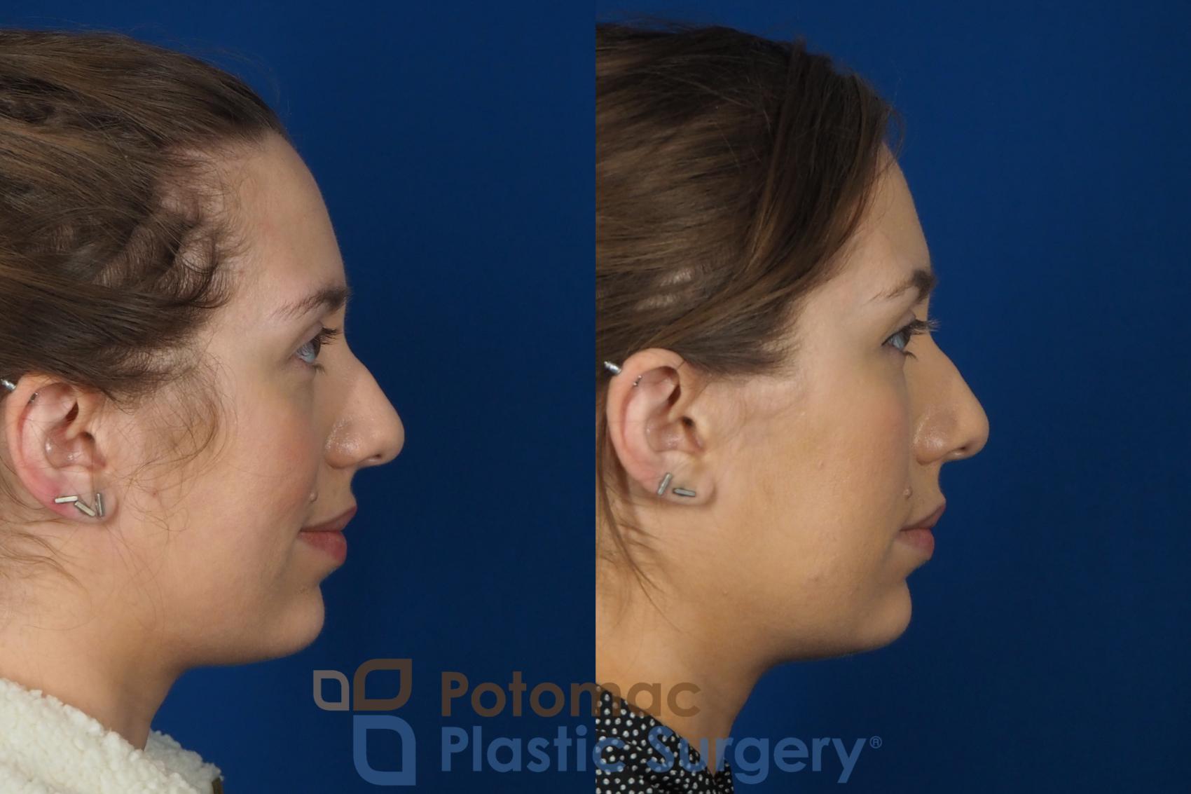 Before & After Dermal Fillers Case 242 Right Side View in Washington DC & Arlington , DC