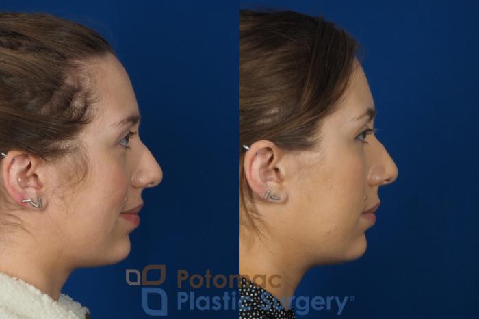 Before & After Botox Cosmetic Case 242 Right Side View in Washington DC & Arlington , DC