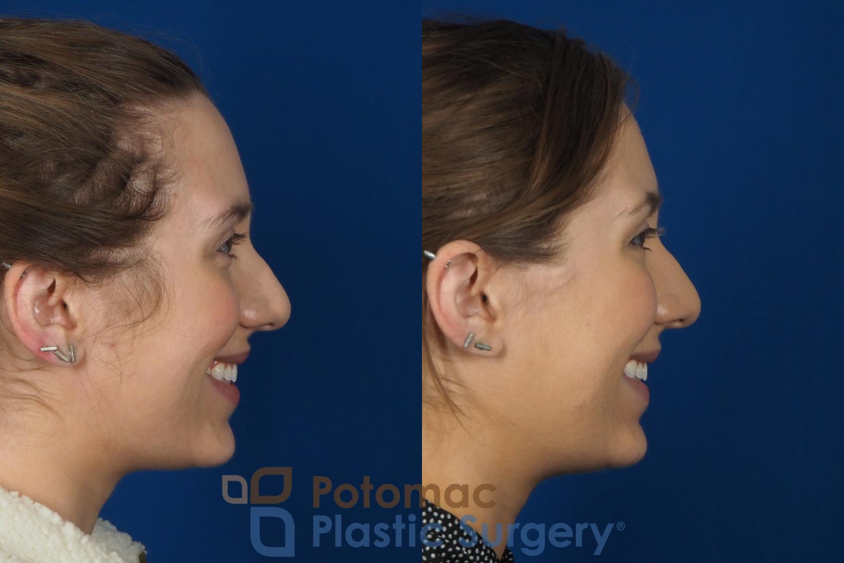 Before & After Dermal Fillers Case 242 Right Side View #2 View in Washington DC & Arlington , DC