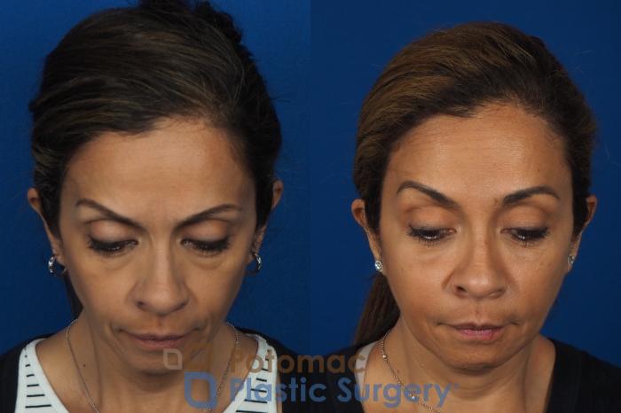Before & After Liquid Facelift Case 268 Above View in Washington DC & Arlington , DC