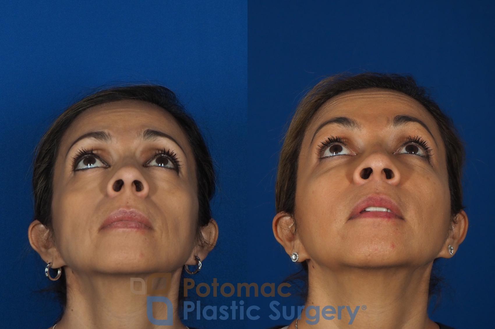 Nonsurgical Liquid Facelift Using Relaxers And Fillers To Rejuvenate The Face Of A Middle Aged Woman 4481