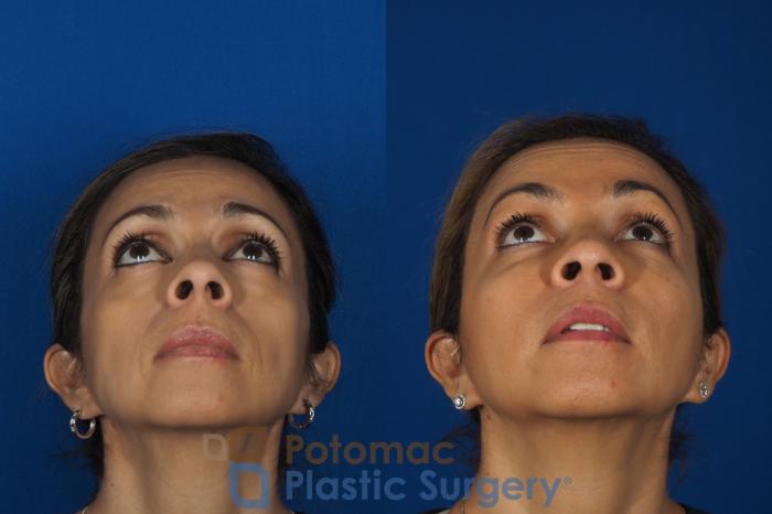Before & After Botox Cosmetic Case 268 Below View in Washington DC & Arlington , DC
