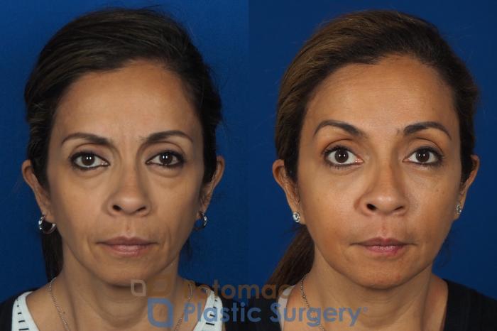 Before & After Botox Cosmetic Case 268 Front View in Washington DC & Arlington , DC