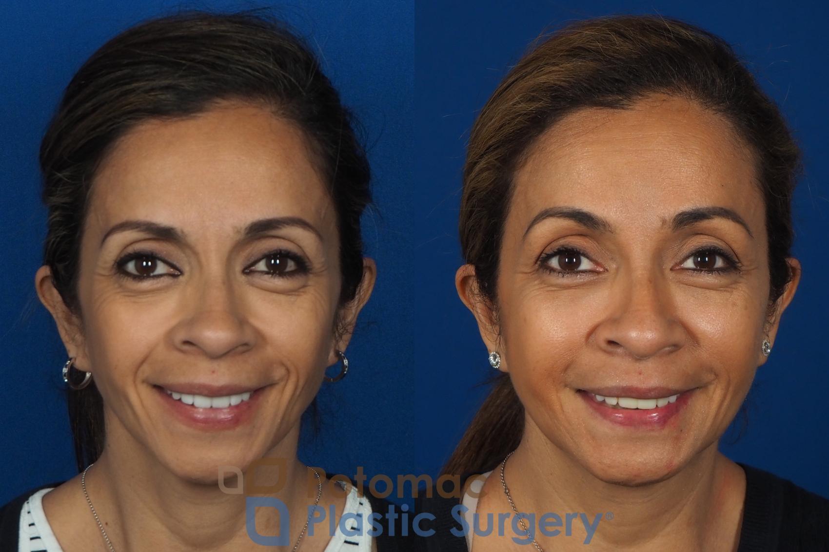 Nonsurgical Liquid Facelift using relaxers and fillers to rejuvenate the face of a middleaged woman