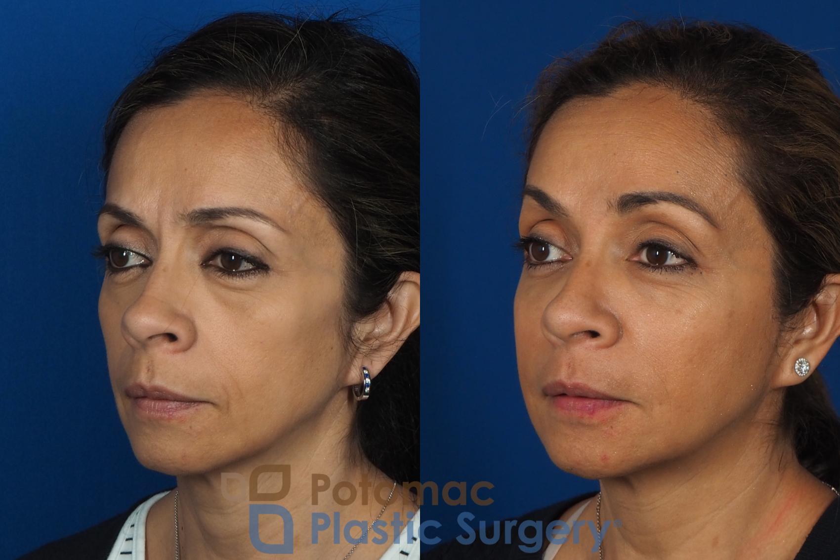 Before & After Liquid Facelift Case 268 Left Oblique View in Washington DC & Arlington , DC