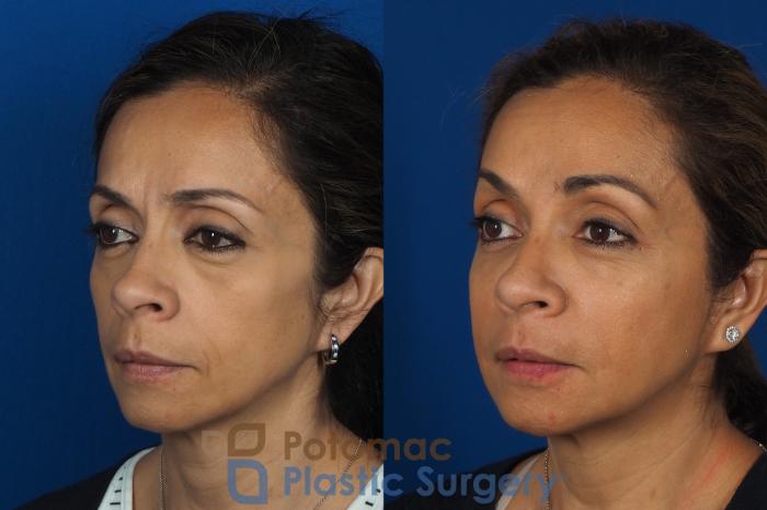 Before & After Botox Cosmetic Case 268 Left Oblique View in Washington DC & Arlington , DC