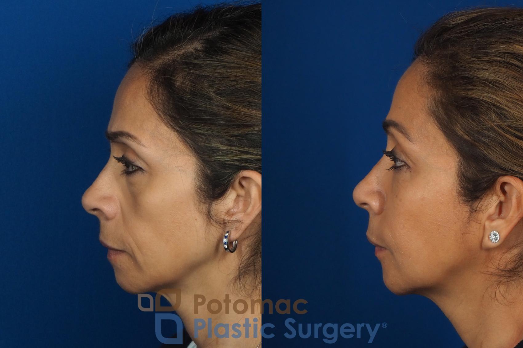 Before & After Liquid Facelift Case 268 Left Side View in Washington DC & Arlington , DC
