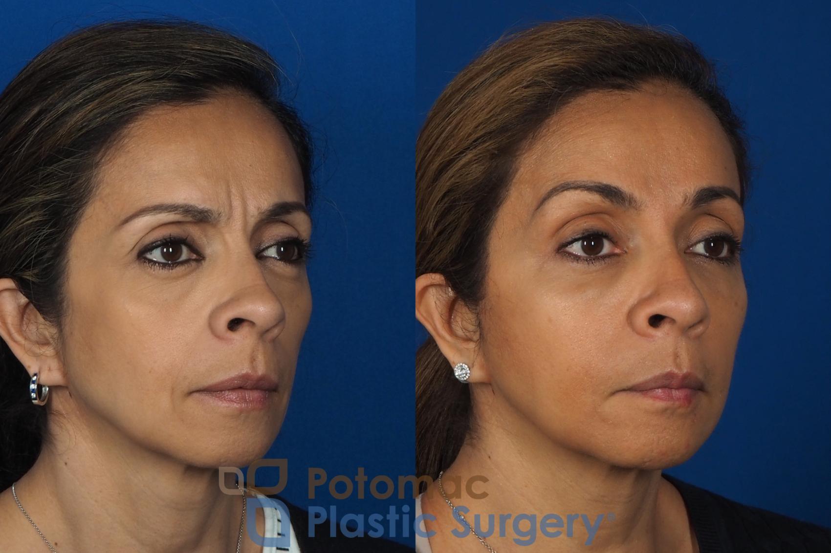 Before & After Liquid Facelift Case 268 Right Oblique View in Washington DC & Arlington , DC