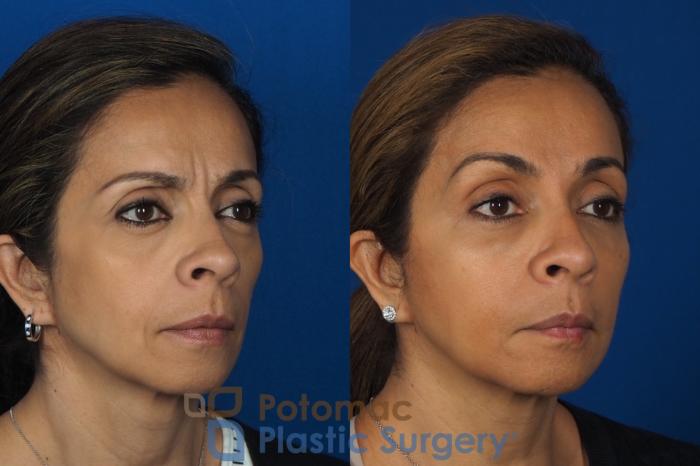 Before & After Dermal Fillers Case 268 Right Oblique View in Washington DC & Arlington , DC