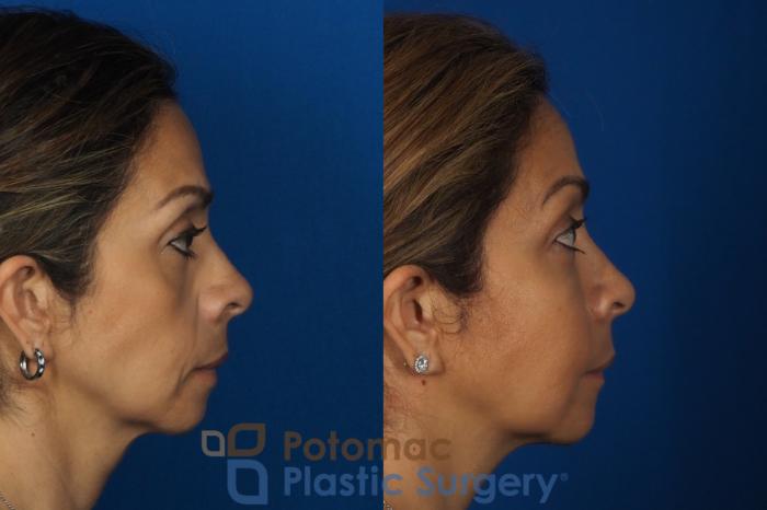 Before & After Botox Cosmetic Case 268 Right Side View in Washington DC & Arlington , DC