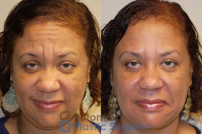 Before & After Liquid Facelift Case 29 Front View in Washington DC & Arlington , DC