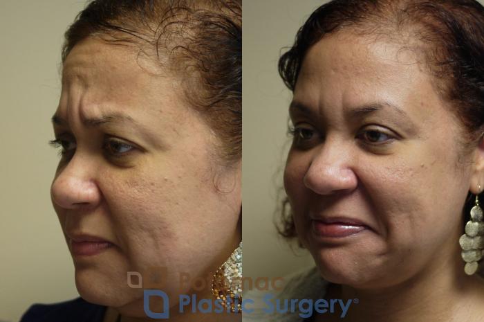 Before & After Botox Cosmetic Case 29 Left Oblique View in Washington DC & Arlington , DC
