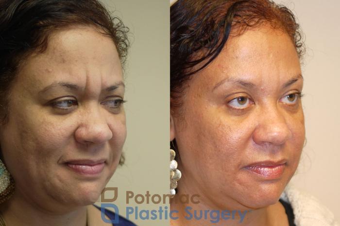 Before & After Botox Cosmetic Case 29 Right Oblique View in Washington DC & Arlington , DC
