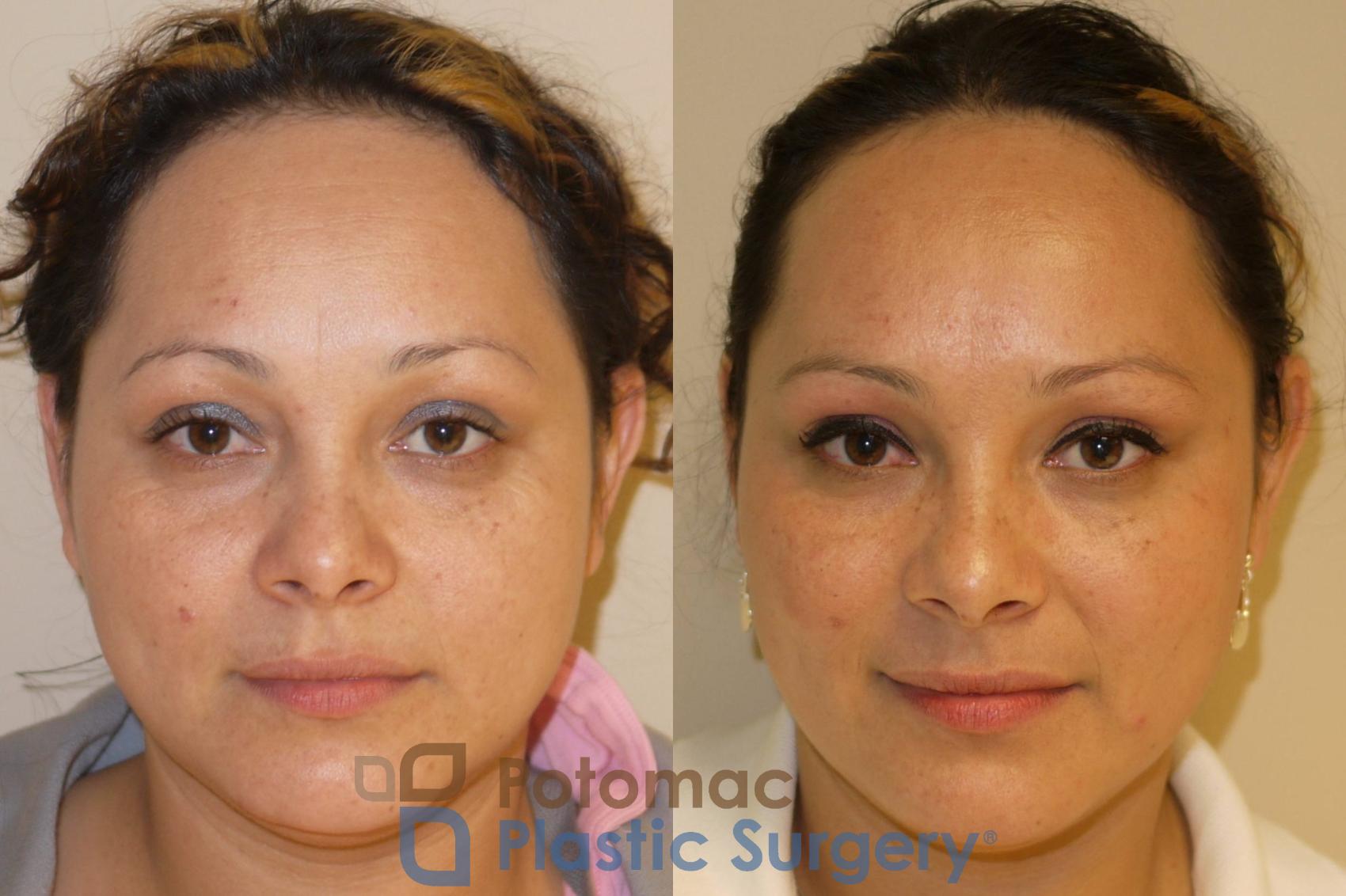 Before & After Skin Care Case 50 Front View in Washington, DC