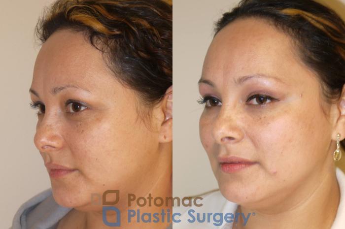 Before & After Skin Care Case 50 Left Oblique View in Washington, DC