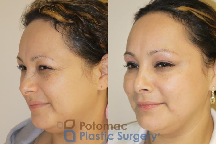 Before & After Skin Care Case 50 Left Oblique View #2 View in Washington, DC