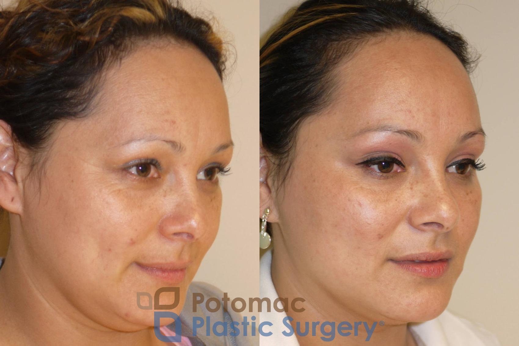 Before & After Liquid Facelift Case 50 Right Oblique View in Washington, DC