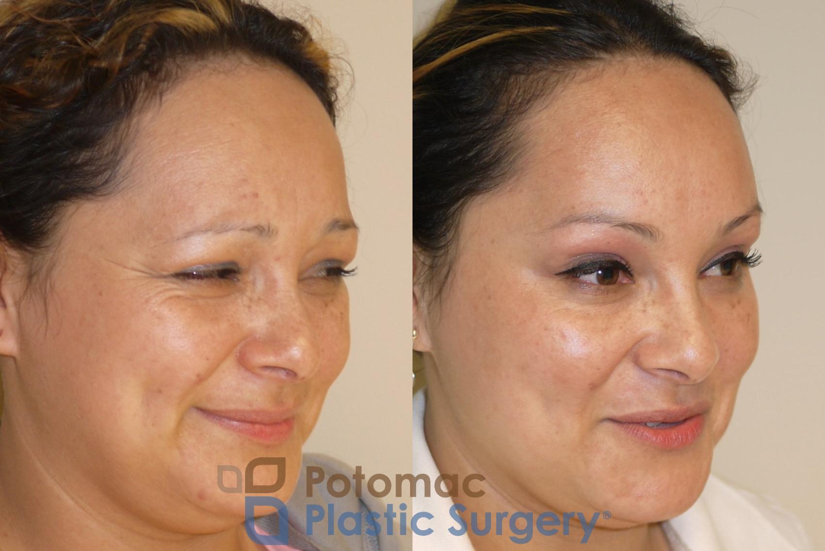 Before & After Liquid Facelift Case 50 Right Oblique View #2 View in Washington, DC