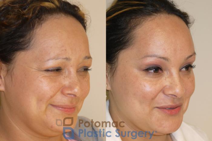 Before & After Skin Care Case 50 Right Oblique View #2 View in Washington, DC