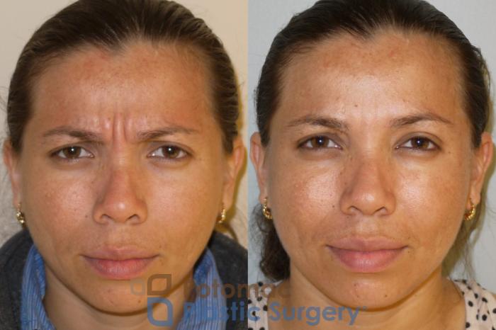 Before & After Skin Care Case 53 Front View #2 View in Washington, DC