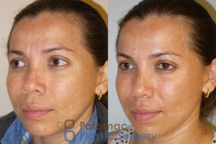 Before & After Skin Care Case 53 Left Oblique View in Washington, DC