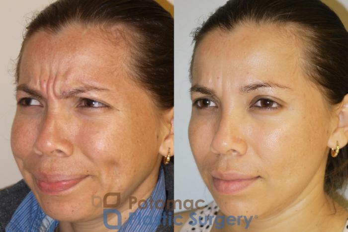 Before & After Skin Care Case 53 Left Oblique View #2 View in Washington, DC