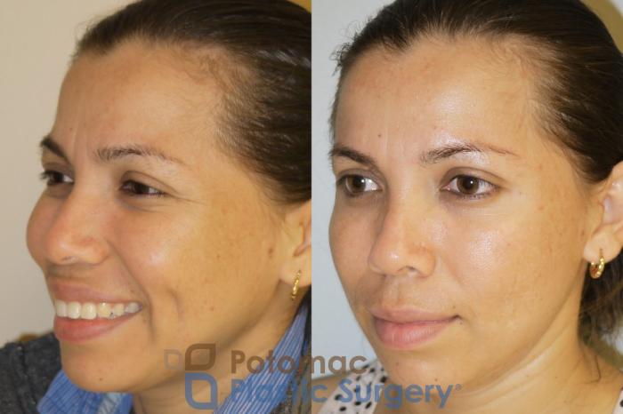 Before & After Skin Care Case 53 Left Oblique View #3 View in Washington, DC
