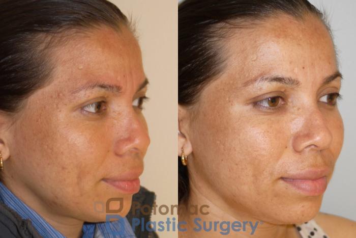 Before & After Skin Care Case 53 Right Oblique View in Washington, DC