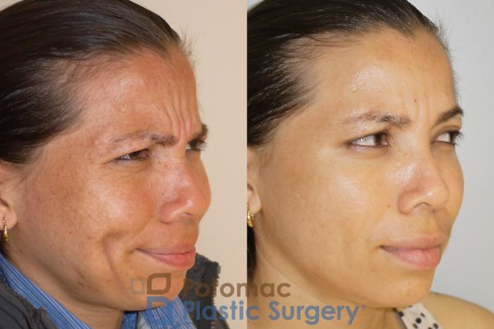Before & After Liquid Facelift Case 53 Right Oblique View #2 View in Washington, DC