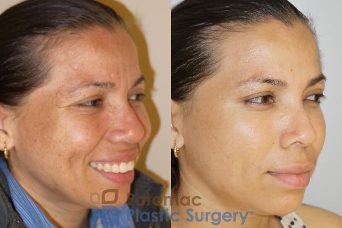 Before & After Skin Care Case 53 Right Oblique View #3 View in Washington, DC