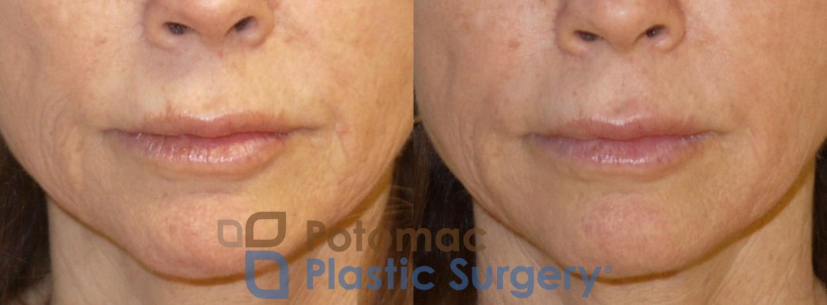Before & After Dermal Fillers Case 76 Front View in Washington DC & Arlington , DC
