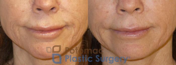 Before & After Liquid Facelift Case 76 Front - Smiling View in Washington DC & Arlington , DC