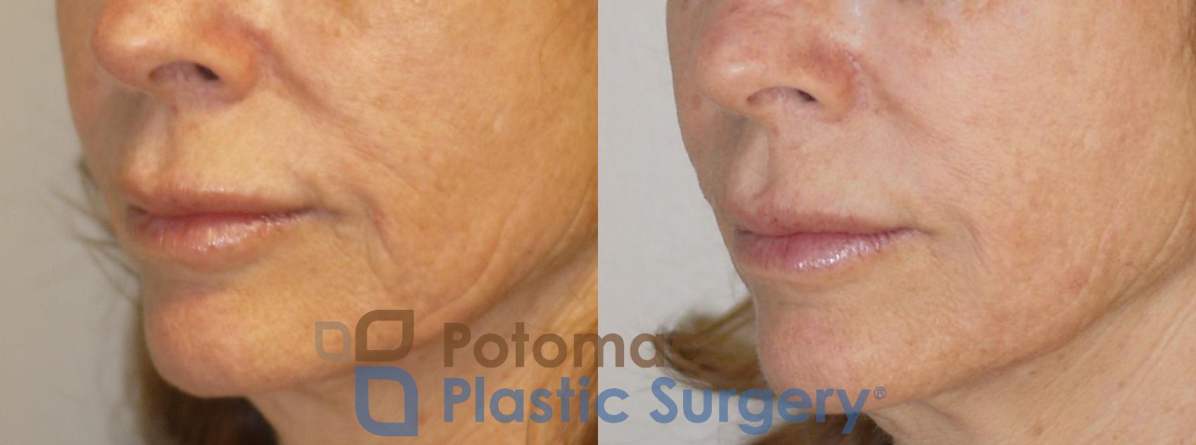 Before & After Liquid Facelift Case 76 Left Oblique View in Washington DC & Arlington , DC