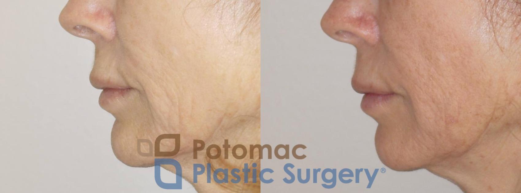 Before & After Liquid Facelift Case 76 Left Side View in Washington DC & Arlington , DC