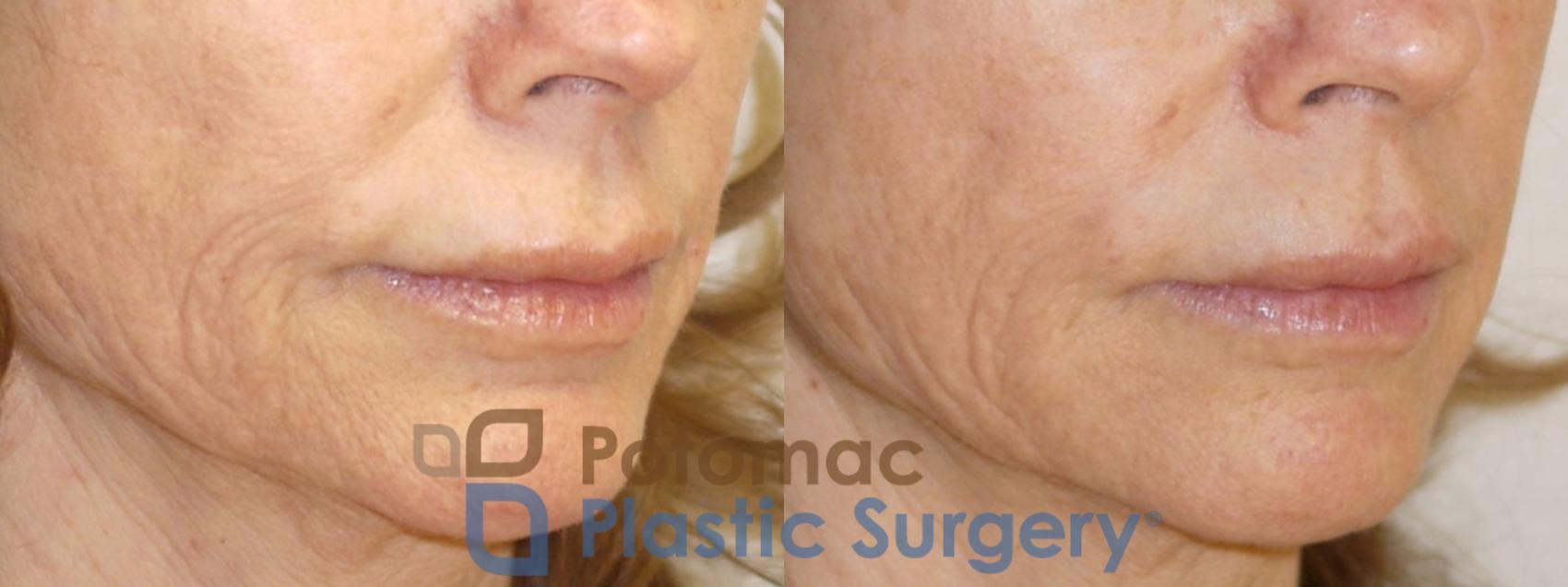 Before & After Liquid Facelift Case 76 Right Oblique View in Washington DC & Arlington , DC