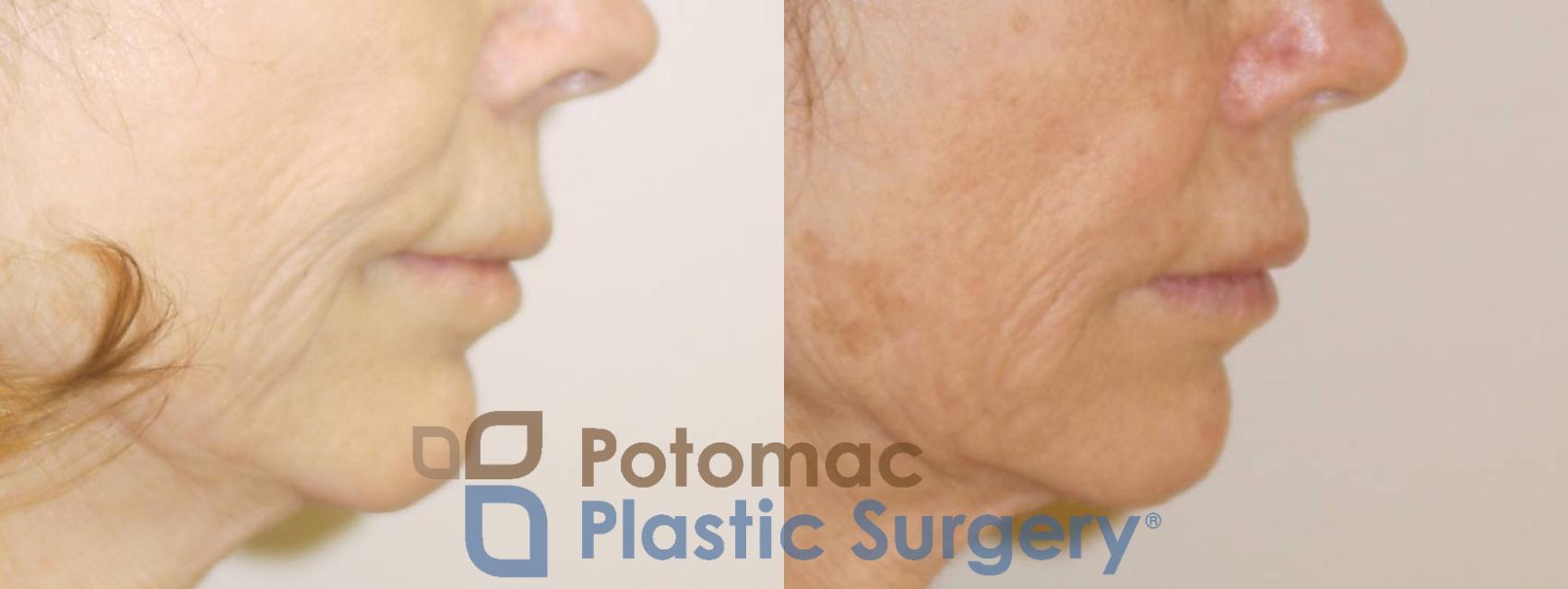 Before & After Liquid Facelift Case 76 Right Side View in Washington DC & Arlington , DC