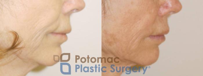 Before & After Liquid Facelift Case 76 Right Side View in Washington DC & Arlington , DC