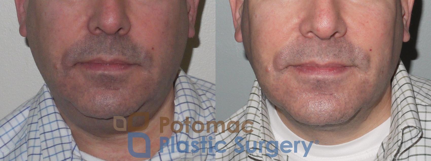 Before & After Neck Lift Case 110 Front View in Washington, DC