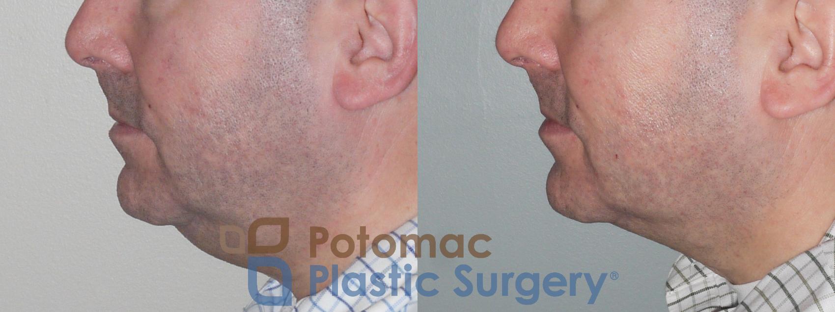 Before & After Neck Lift Case 110 Left Side View in Washington, DC