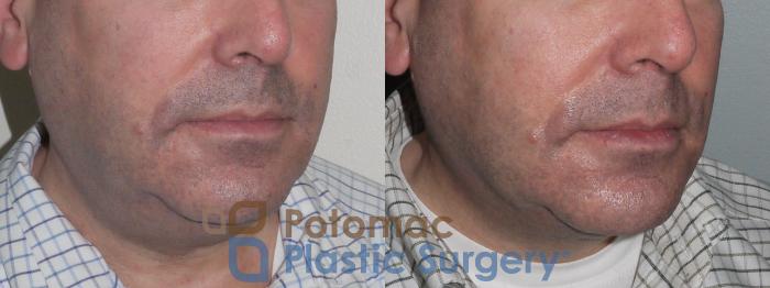 Before & After Neck Lift Case 110 Right Oblique View in Washington, DC