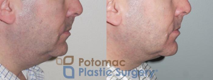 Before & After Neck Lift Case 110 Right Side View in Washington, DC