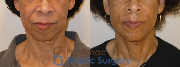 Before & After Neck Lift Case 154 Front View in Washington, DC