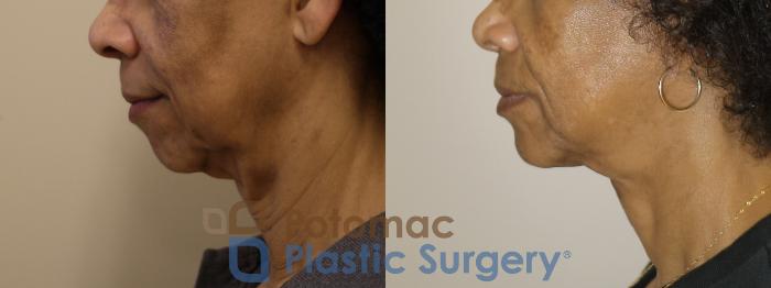 Before & After Neck Lift Case 154 Left Side View in Washington, DC