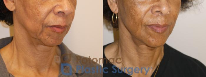 Before & After Neck Lift Case 154 Right Oblique View in Washington, DC