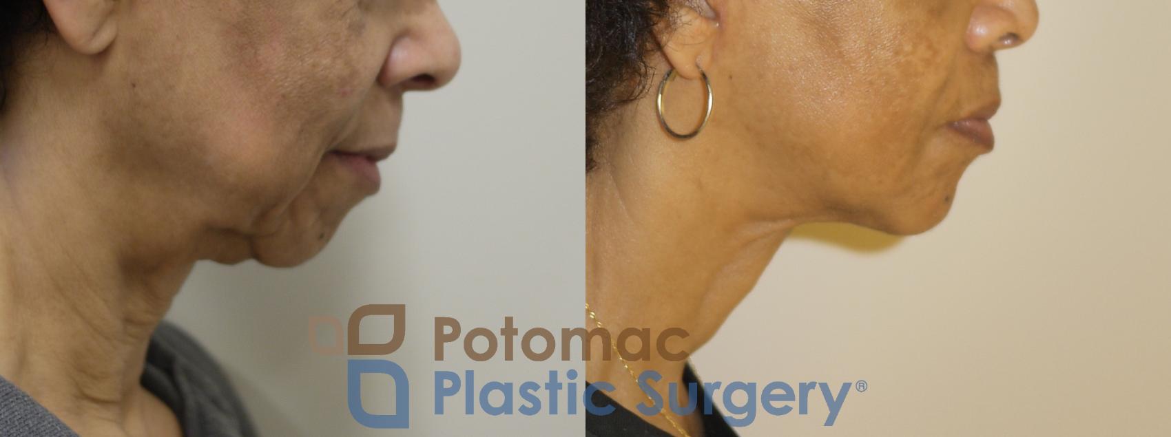 Before & After Neck Lift Case 154 Right Side View in Washington, DC