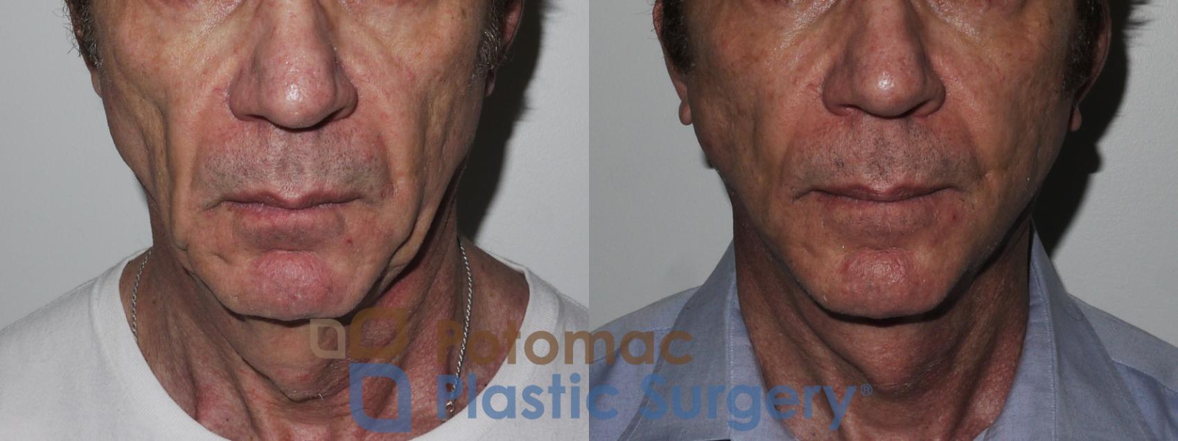 Before & After Liposuction Case 177 Front View in Washington, DC