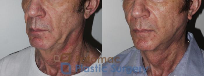 Before & After Liposuction Case 177 Left Oblique View in Washington DC & Arlington , DC