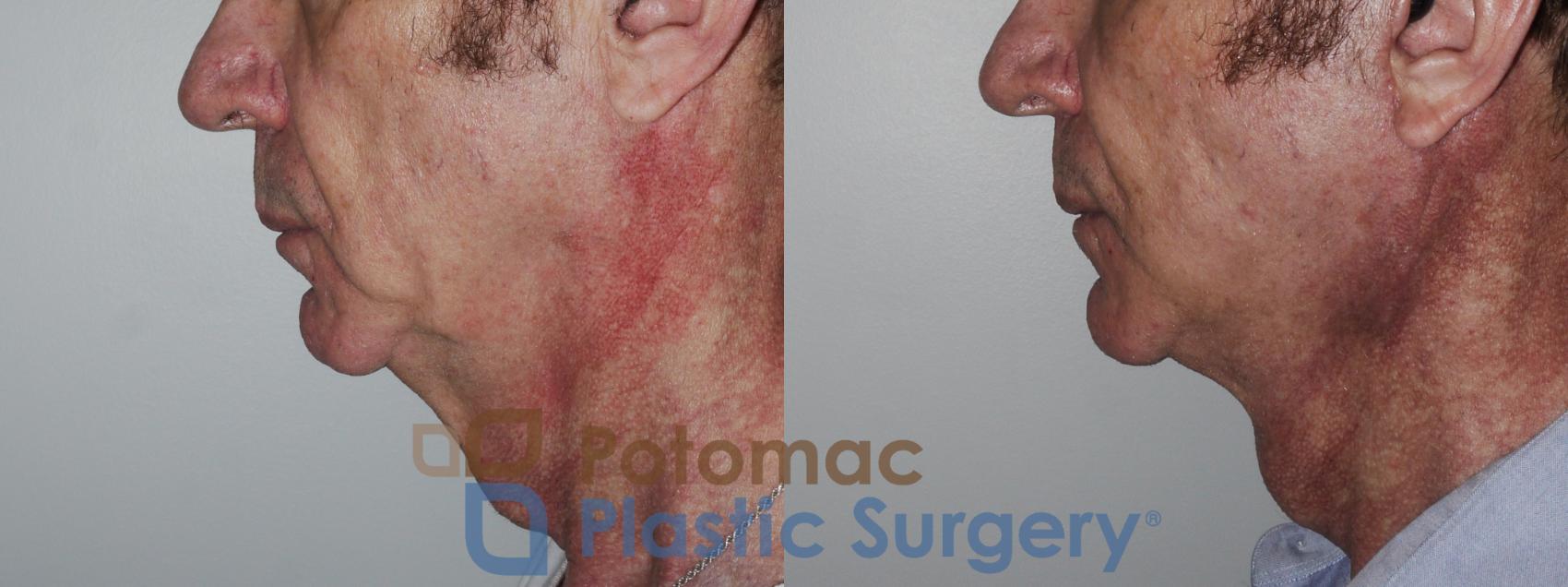 Before & After Neck Lift Case 177 Left Side View in Washington, DC