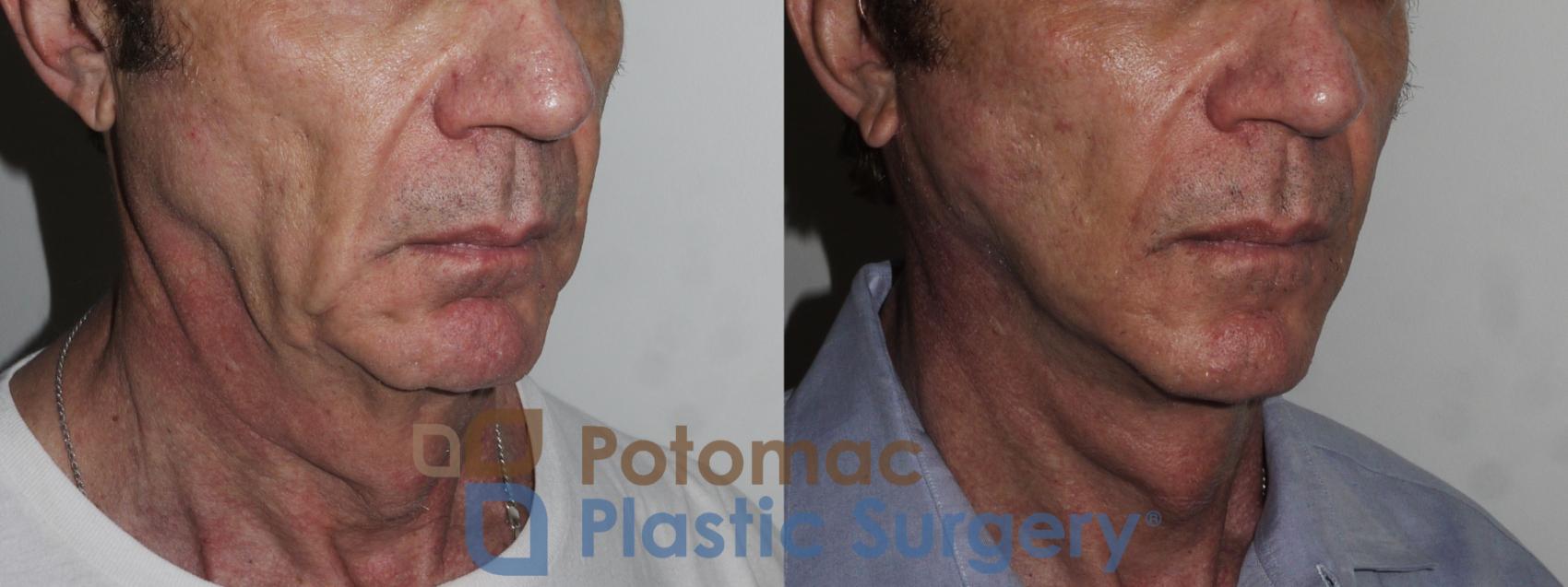 Before & After Neck Lift Case 177 Right Oblique View in Washington, DC