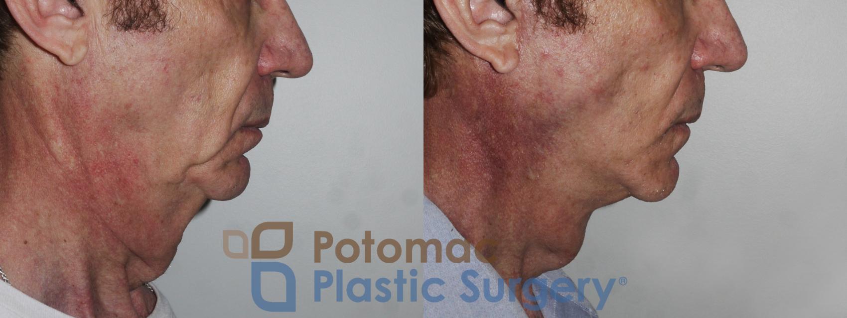 Before & After Neck Lift Case 177 Right Side View in Washington, DC